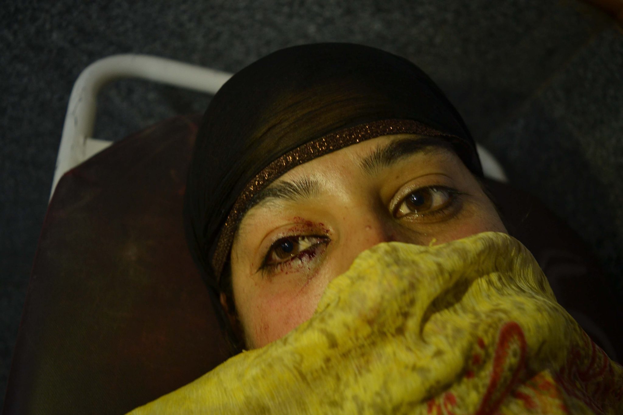 Aug. 30, 2019, Soura, Kashmir — Mysar, one of many women who sustained injuries during protests in Soura, a neighborhood of Srinagar. The neighborhood has been the site of weekly Friday protests since August 5 when the central government repealed Jammu and Kashmir’s special status.